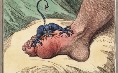 Gout – Nguy hiểm khi biến chứng